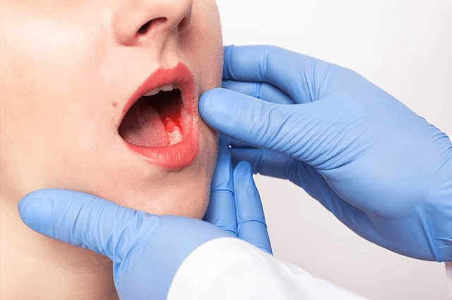 ओरल कैंसर के कारण और लक्षण - Chirayu Cancer Hospital